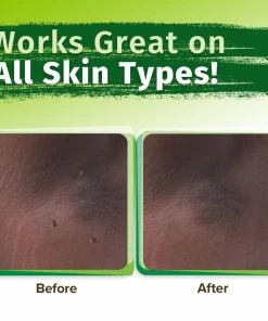 Hempvana End Tag Skin Tag Remover - As Seen On TV Accessories