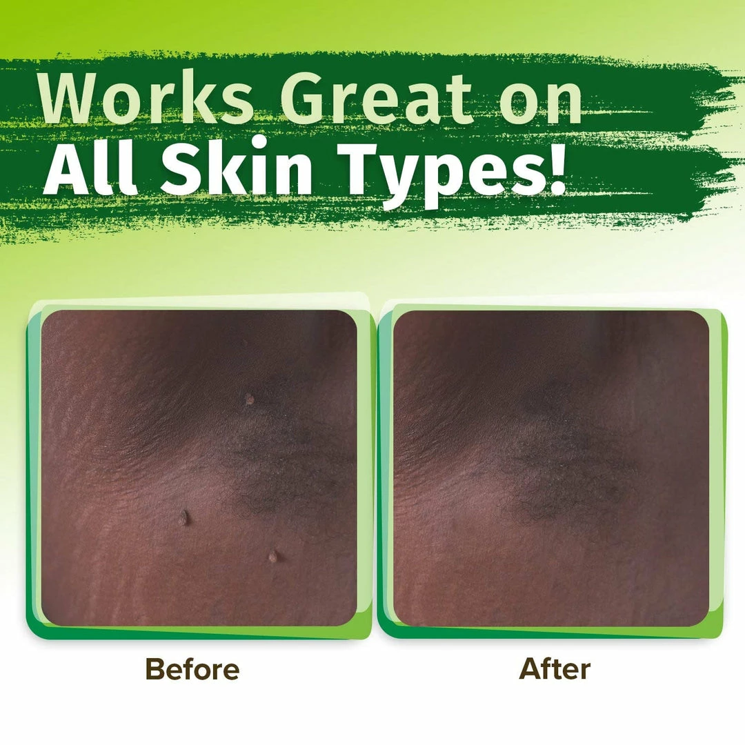 Hempvana End Tag Skin Tag Remover - As Seen On TV Accessories