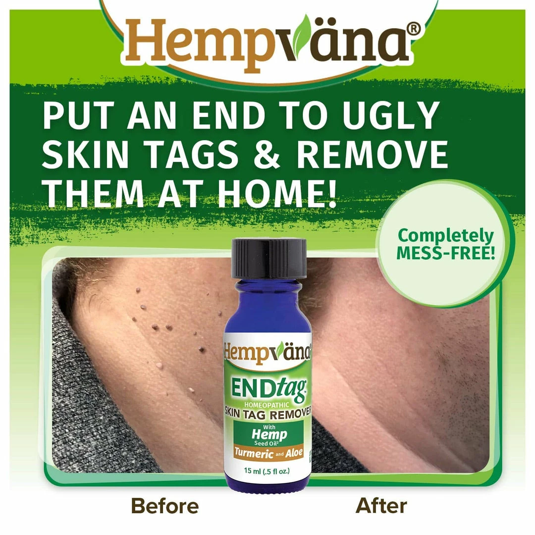Hempvana End Tag Skin Tag Remover - As Seen On TV Accessories